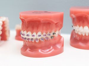 Braces Colours: Choosing The Right One « Smile Team Orthodontics | Blog